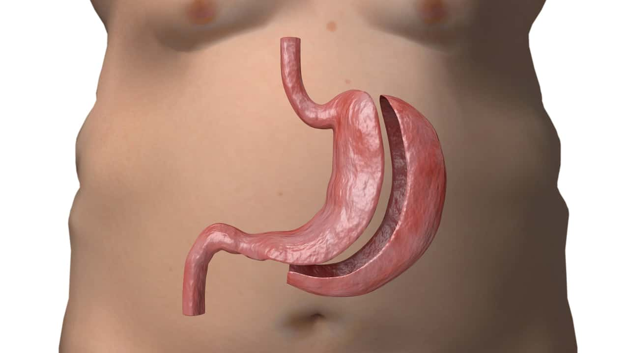 Cirurgia bariátrica o que você precisa saber sobre o procedimento