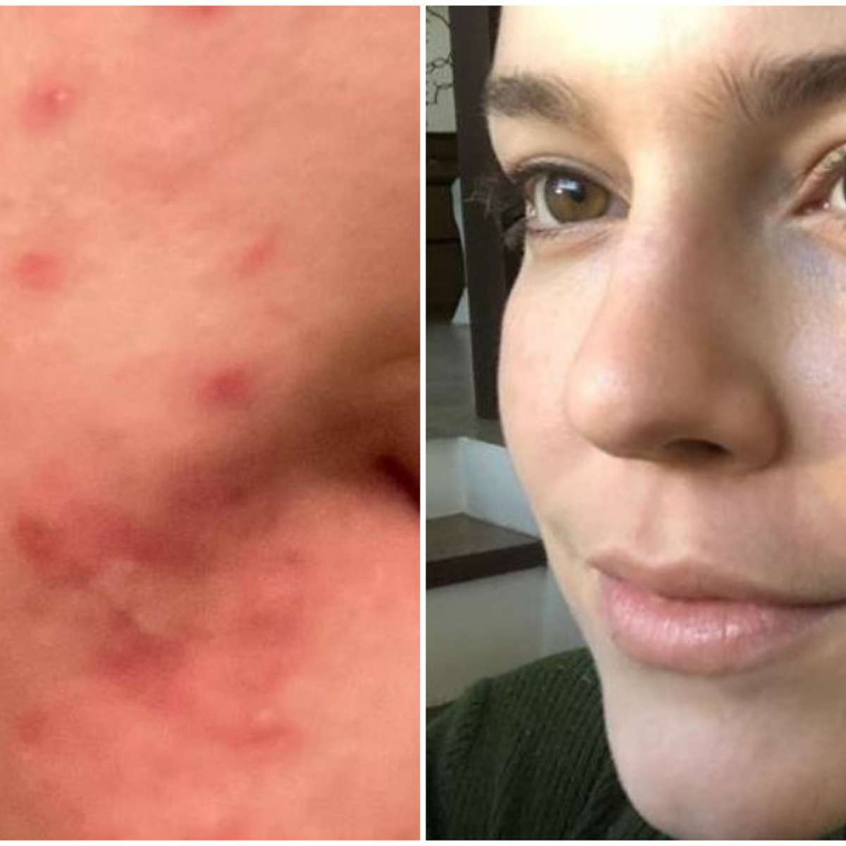 Alice Wegmann mostra antes e depois de rosto com espinhas e dá dicas