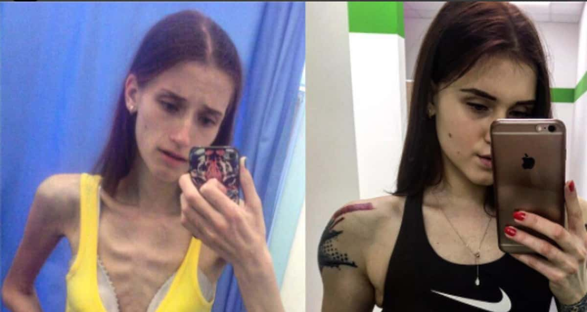 Anorexia: jovem que ficou uma semana sem comer vira vegana e conta sua  história de superação