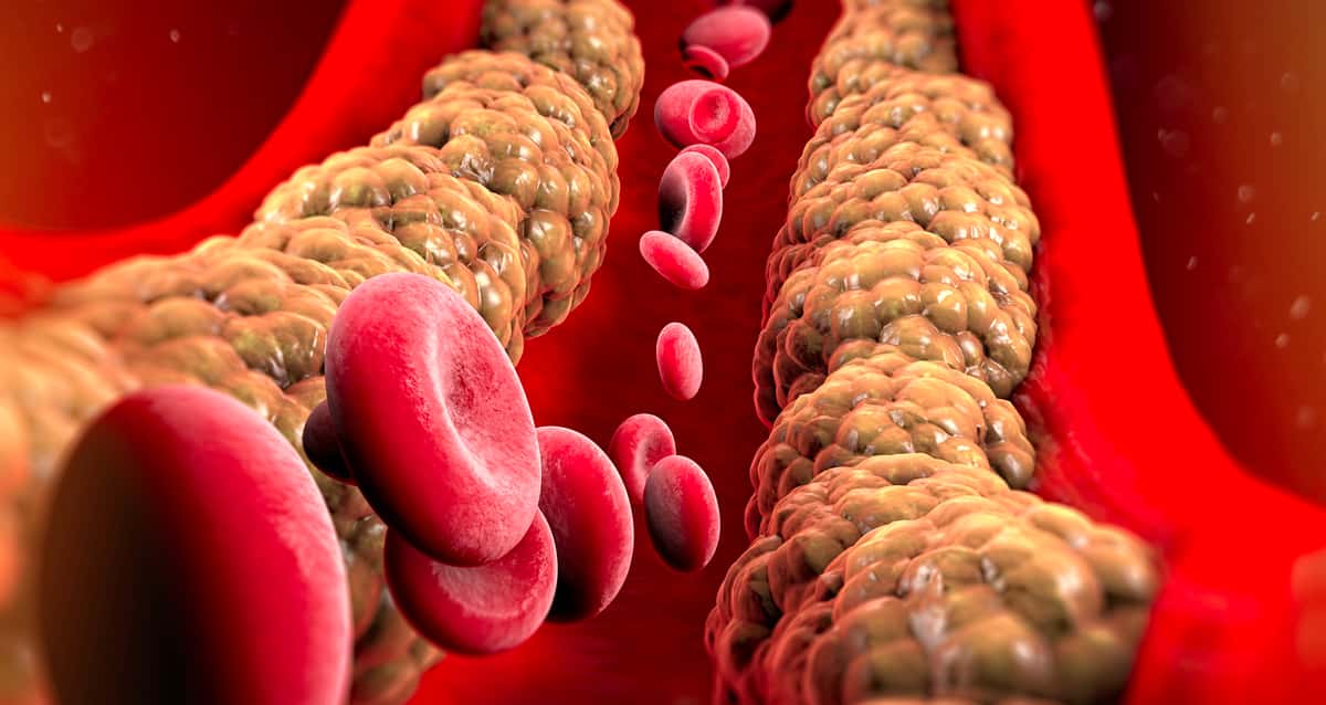 4 Möglichkeiten, die Ihnen helfen, den Cholesterinspiegel auf natürliche Weise zu senken
