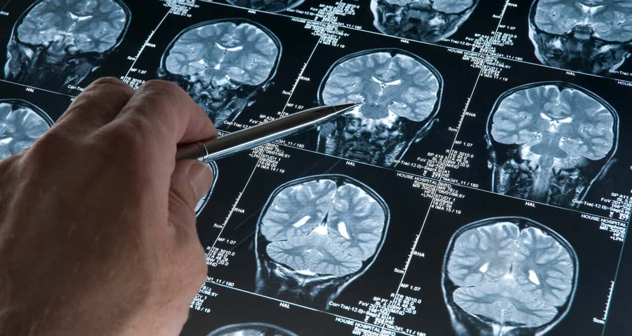 Sinal precoce de Alzheimer surge até 25 anos antes dos sintomas