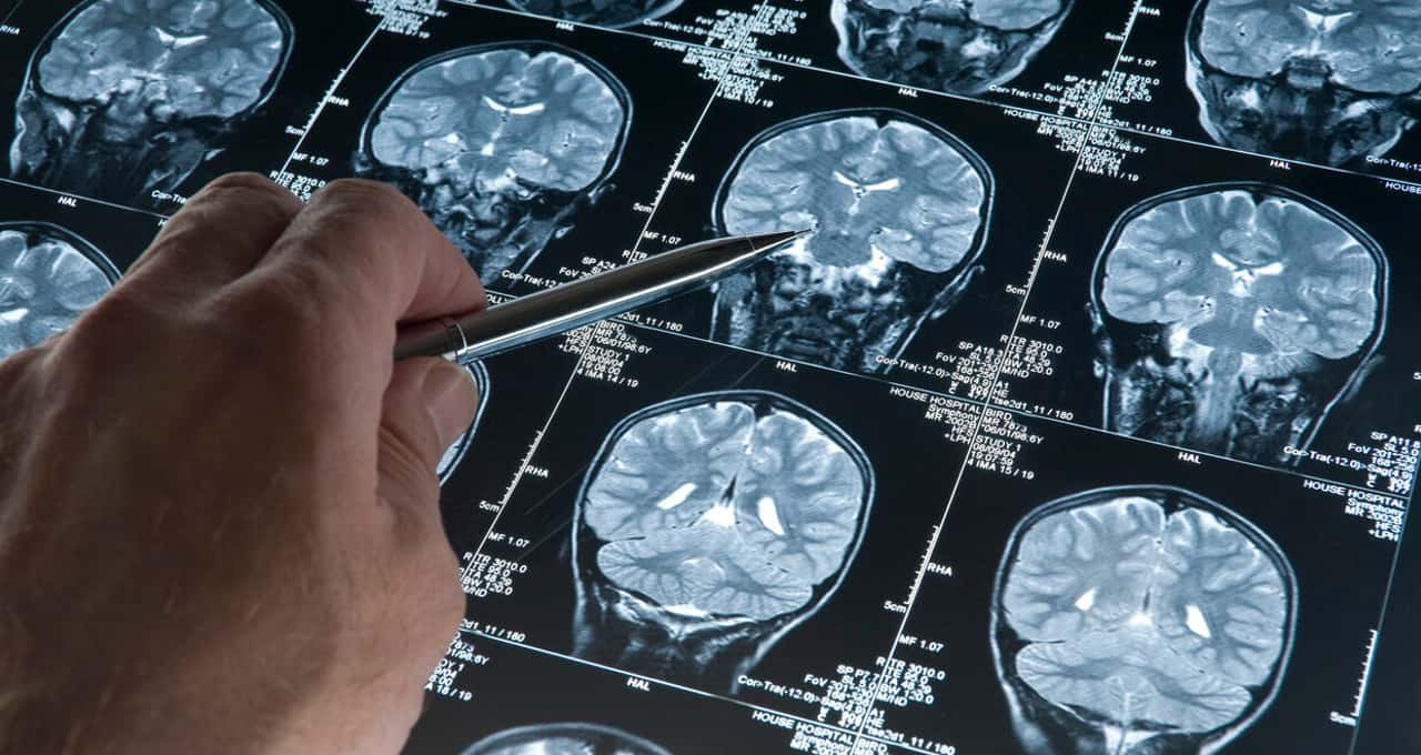 Saiba como reconhecer sinais de Alzheimer em outra pessoa