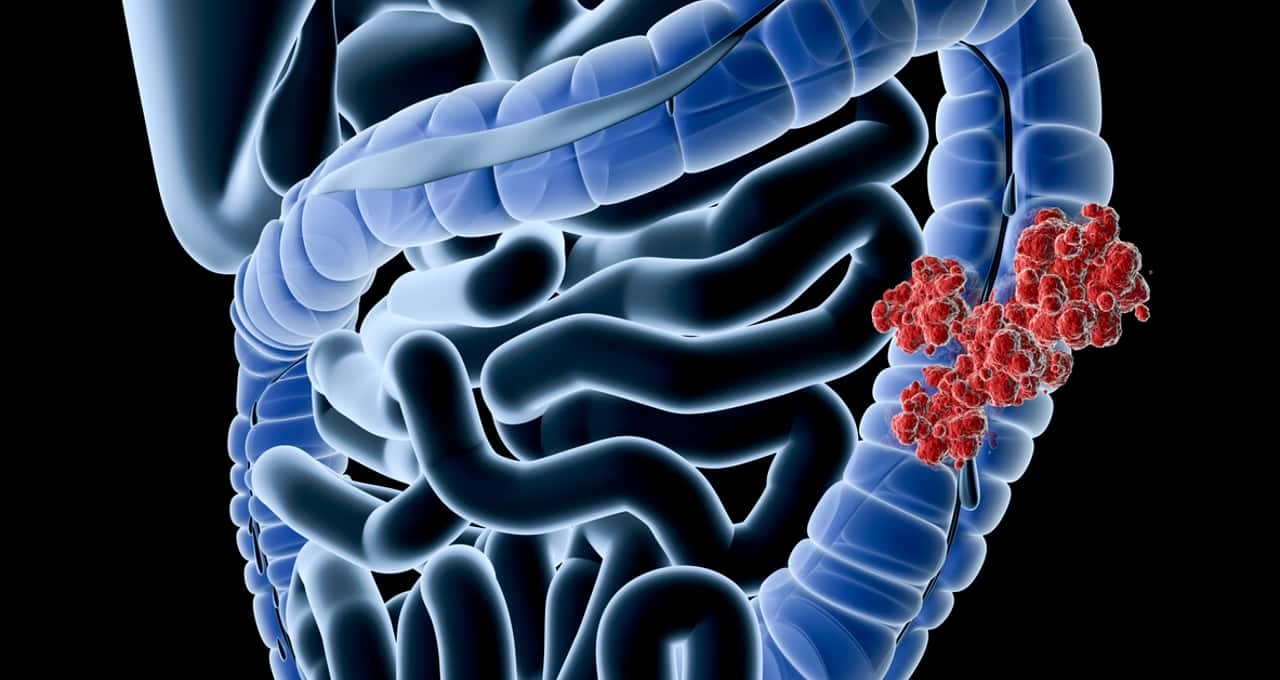 Alerta para jovens: principais causas do câncer de intestino e como prevenir