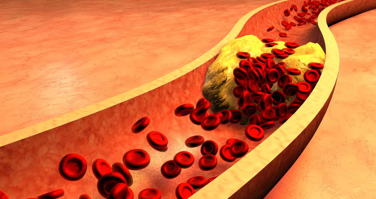 6 formas eficazes de reduzir o colesterol ruim e evitar doenças crônicas