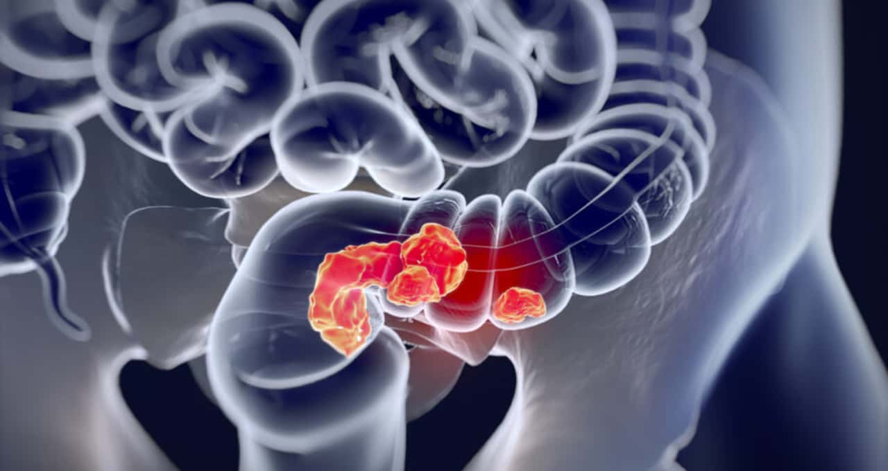 Folato reduz risco de câncer de intestino em até 7%