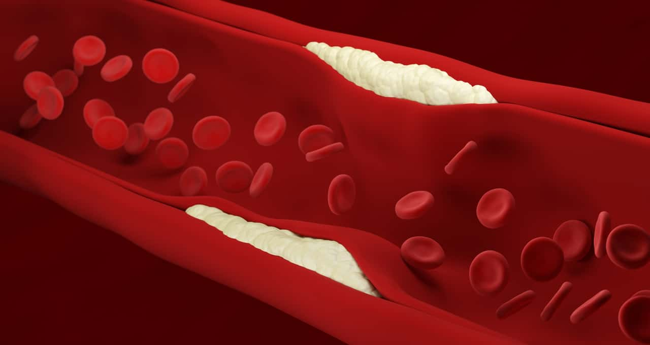 Conheça os sintomas do colesterol alto e aprenda a controlá-los