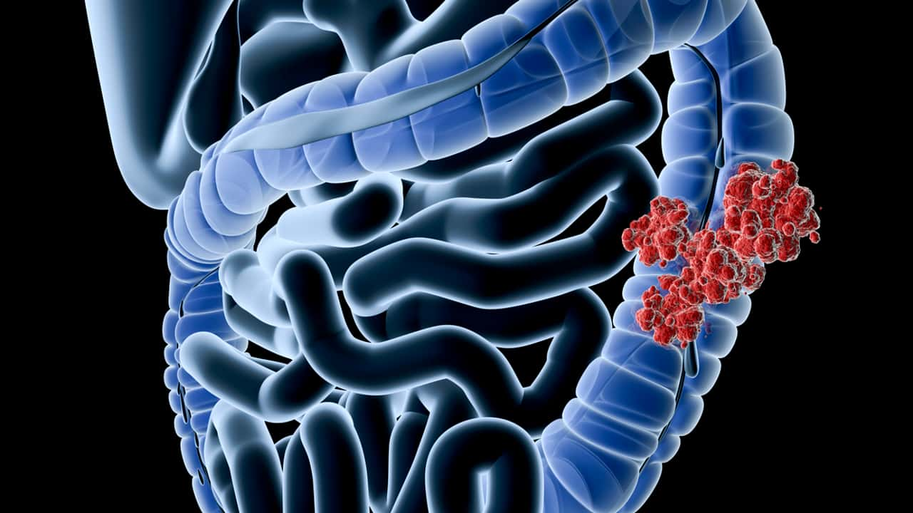 Estudo Mostra Que Dieta Rica Em Folato Reduz Câncer De Intestino