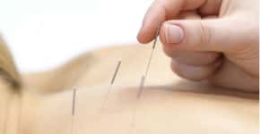 Saiba onde fazer tratamento de acupuntura pagando pouco