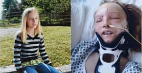 Garota que teve rosto desfigurado por acidente passa por cirurgia de reconstrução facial
