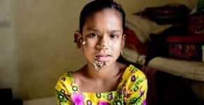 Garota de Bangladesh tem suspeita de “síndrome do homem árvore”