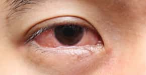 Coçar os olhos pode provocar doença ocular, alerta oftalmologista
