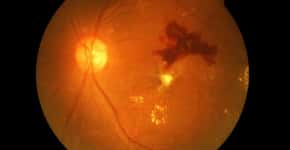 Retinopatia diabética pode causar cegueira irreversível