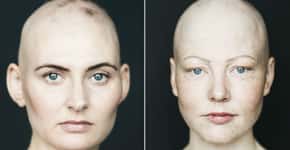 Fotógrafa captura retratos de pessoas com alopecia