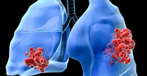 DNA de lesão pré-maligna de pulmão pode ser detectado no sangue