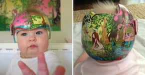 Artista decora capacetes de bebês com deformação craniana