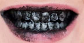 Clareamento com carvão ativado pode desgastar os dentes