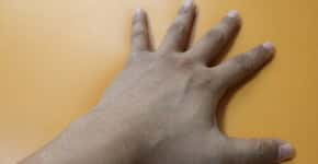 Dedos podem revelar se homem é esquizofrênico