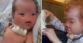 Menina que nasceu sem nariz vai ganhar prótese impressa em 3D