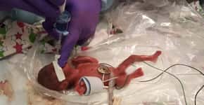 Bebê que nasceu com 245 gramas recebe alta do hospital