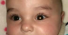 Foto com flash pode detectar tumor ocular comum na infância
