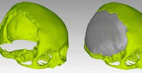 Jovem recebe prótese de titânio no crânio feita sob medida