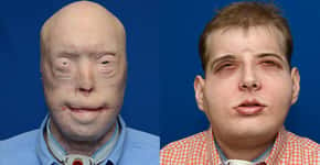 Homem recebe transplante de rosto mais extensivo da história