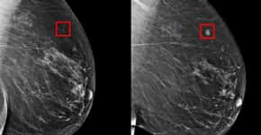 Ferramenta do MIT prevê câncer de mama com 5 anos de antecedência