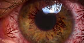 Doença causada por lente de contato leva mulher a retirar o olho