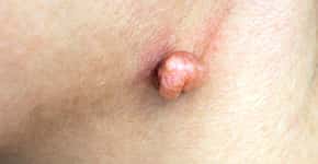 HPV: sintomas, causas e onde fazer o tratamento
