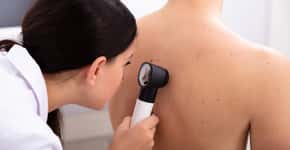 Dermatologistas oferecem exame preventivo de câncer de pele