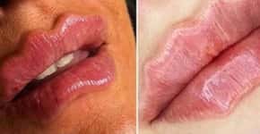 ‘Devil lips’: nova tendência de preenchimento pode trazer riscos