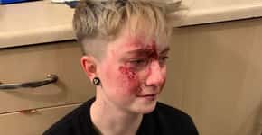 Jovem lésbica sofre 6º ataque homofóbico e fica ensanguentada