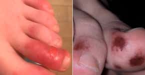 Lesões na ponta dos dedos podem ser uma manifestação de covid-19