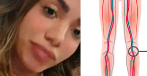 Conheça os sinais de trombose, doença que fez Anitta ser internada