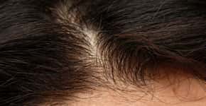 Covid-19 afeta cabelo de homens e mulheres, apontam médicos