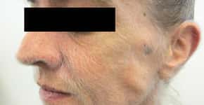 Mulher com câncer desenvolve raro crescimento de pelos no rosto