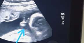 Bebê faz ‘v de vitória’ em ultrassom e pai com câncer raro vê sinal