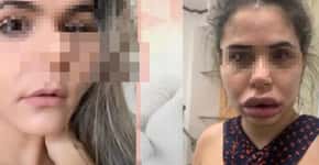 Dentista é acusada de deformar rosto de 40 mulheres após harmonização facial