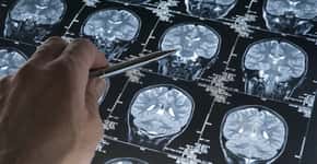 Doença cerebral desconhecida coloca médicos em alerta