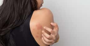 Sinais na pele podem aparecer em até 4 semanas após início da covid-19