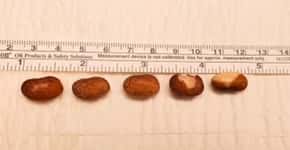 Médicos retiram seis grãos de feijão do canal do pênis de paciente