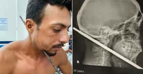 Homem sobrevive após ferro atravessar seu pescoço: ‘Sou um milagre’
