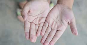 Covid: pacientes relatam dedos enrugados e outros sintomas estranhos