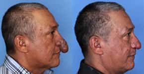 Homem com inflamação crônica que deforma o nariz faz rinoplastia