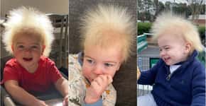 Conheça a síndrome rara que faz cabelo de menino estar sempre arrepiado