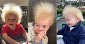 Conheça a síndrome rara que faz cabelo de menino estar sempre arrepiado