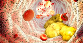 Sinais de alerta de colesterol alto que pode levar à amputação
