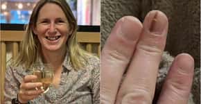 Após mancha na unha, mulher descobre câncer e precisa amputar o dedo