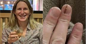 Após mancha na unha, mulher descobre câncer e precisa amputar o dedo