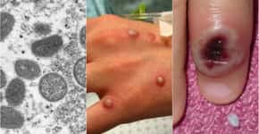 Varíola do macaco: sintomas que aparecem antes das bolhas na pele